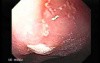 Linitis Plastica - Endoscopy (1 of 3)