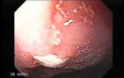 Linitis Plastica - Endoscopy (1 of 3)