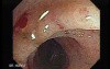 Radiation Enteritis (3 of 4)