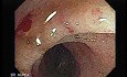 Radiation Enteritis (3 of 4)