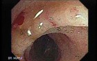 Radiation Enteritis (3 of 4)