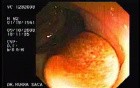 A Tablet of Medicine in the Colon (1 of 2)