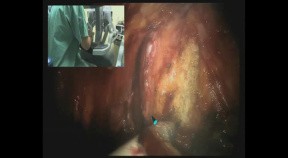 Robotic prostatectomy in HD - DaVinci Surgery - part 1