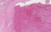 Artery - Thrombus, Atherosclerotic Plaque