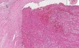Artery - Thrombus, Atherosclerotic Plaque