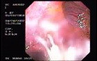 Crohn's Disease - Endoscopy (7 of 28)