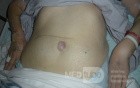 Sister Mary Joseph Nodule