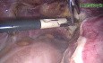 Total Excision of the Uterus by Use of Laparoscopy