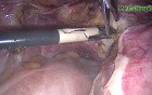 Total Excision of the Uterus by Use of Laparoscopy