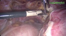Total Excision of the Uterus by Use of Laparoscopy