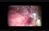 Robot-assisted Laparoscopic Right Hemihepatectomy