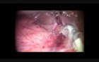 Robot-assisted Laparoscopic Right Hemihepatectomy