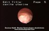 Hysteroscopic Aspect Of Endometrial Cancer