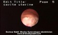 Hysteroscopic Aspect Of Endometrial Cancer