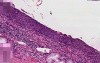 Carcinoma in situ - Histopathology - Lung, bronchus