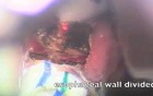 Diverticulotomy - Endoscopy