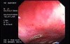Radiation Proctosigmoiditis (13 of 14)