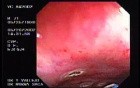 Radiation Proctosigmoiditis (13 of 14)