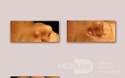 tumor Of The Skin Of The Nose