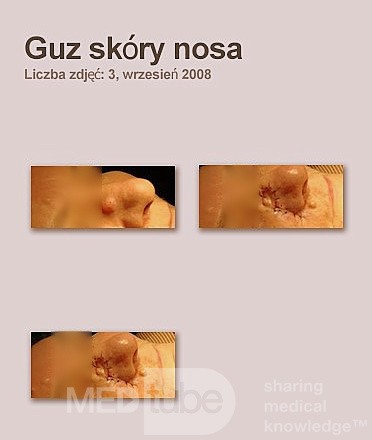 tumor Of The Skin Of The Nose