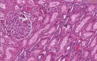 Eclampsia