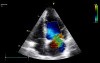 Ruptured Papillary Muscle as a Cause of Acute Mitral Regurgitation