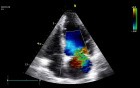 Ruptured Papillary Muscle as a Cause of Acute Mitral Regurgitation