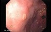 Intestinal Metaplasia - Endoscopy (2 of 5)
