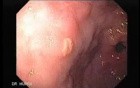 Intestinal Metaplasia - Endoscopy (2 of 5)