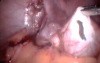 Laparoscopic Cystectomy