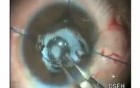 Pupillary Membranes - Fugo Blade Cut