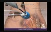 Single Incision Laparoscopic Colectomy utilizing SILS port - 3D Medical Animation
