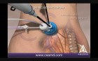 Single Incision Laparoscopic Colectomy utilizing SILS port - 3D Medical Animation