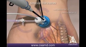 Single Incision Laparoscopic Colectomy utilizing SILS port - 3D Medical Animation