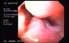 Gastric Carcinoma - Argon Plasma Coagulation (APC) Treatment (8 of 8)