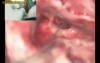 Cochlear Implantation - Part 2