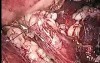 Laparoscopic Ureterolithotomy Retroperitoneal after failed ESWL