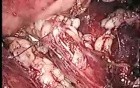 Laparoscopic Ureterolithotomy Retroperitoneal after failed ESWL