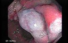 Cap polyposis that resemble a adenocarcinoma of the rectum (4 of 7)