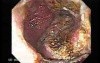 Multiple Adenomatous Polyps Of The Rectum (14 of 37)