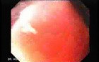 Gastric Cancer - Intestinal Metaplasia - Endoscopy (1 of 7)