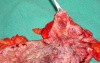 Severe case of Ischemic Colitis (17 of 19)