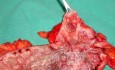 Severe case of Ischemic Colitis (17 of 19)