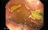 Duodenal Ulcers (2 of 4)