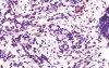 Non-Hodking Lymphoma B Cells. MALT (mucosa associated lymphoid tissue) (7 of 7)