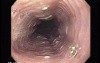 Candida Esophagitis - Endoscopy - Characteristic Appearance