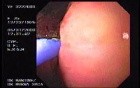 Upper Gastrointestinal Bleeding (9 of 15)