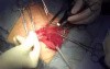 Inguinal hernia repair with semiabsorbable mesh
