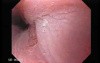 Barrett's Esophagus of long segment (7 of 24)