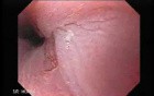 Barrett's Esophagus of long segment (7 of 24)